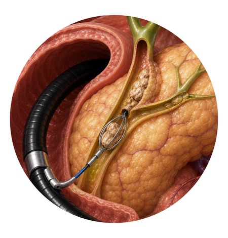 Pancreatic Stone Removal